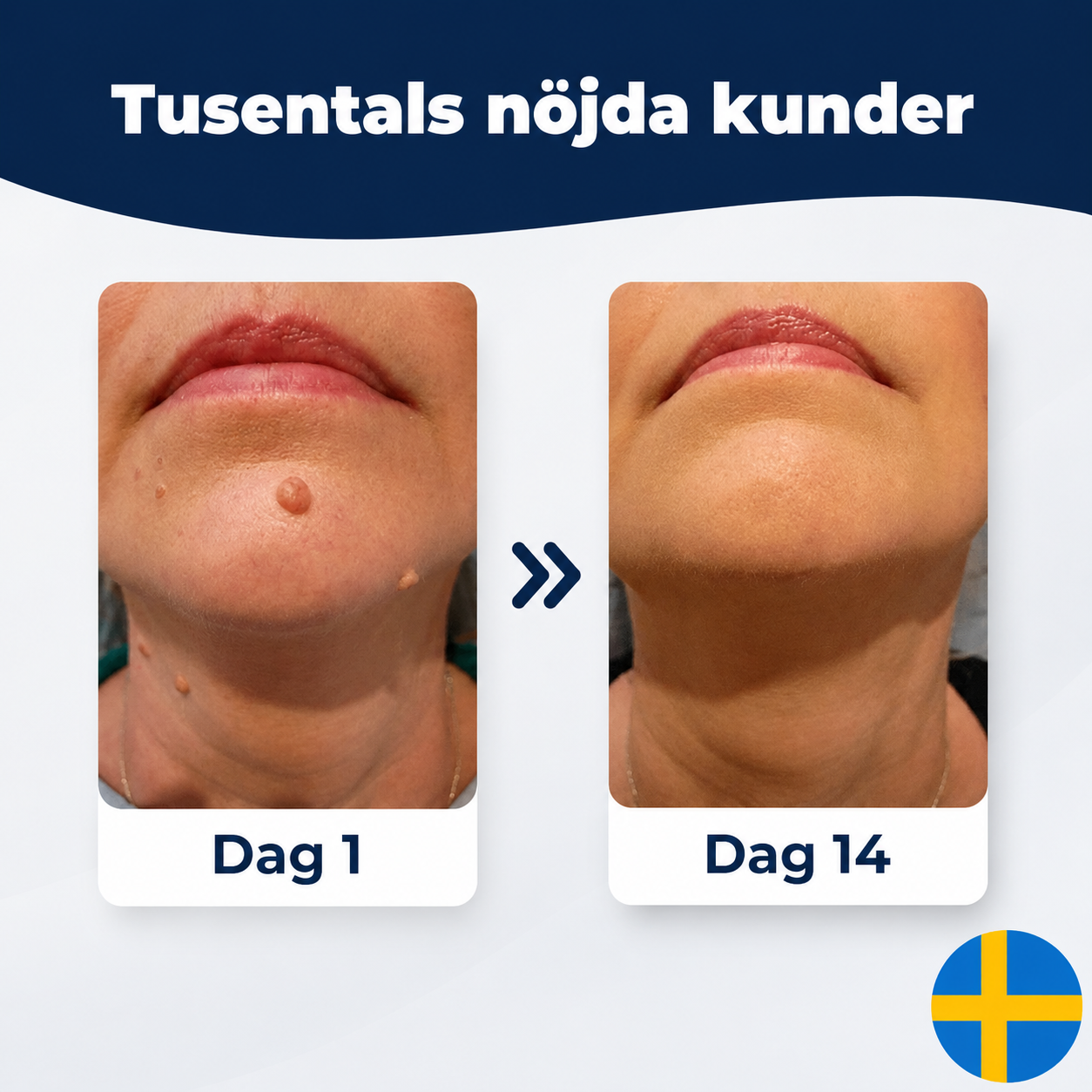 DermaTag™ | Bli av med hudflikar enkelt och hemma