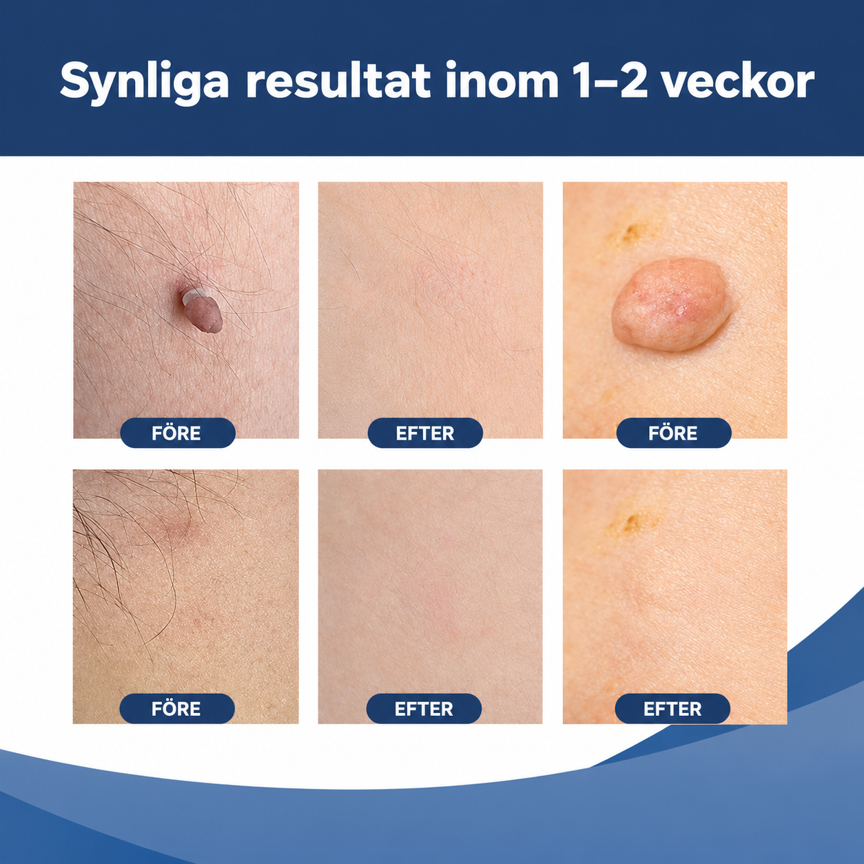 DermaTag™ | Bli av med hudflikar enkelt och hemma