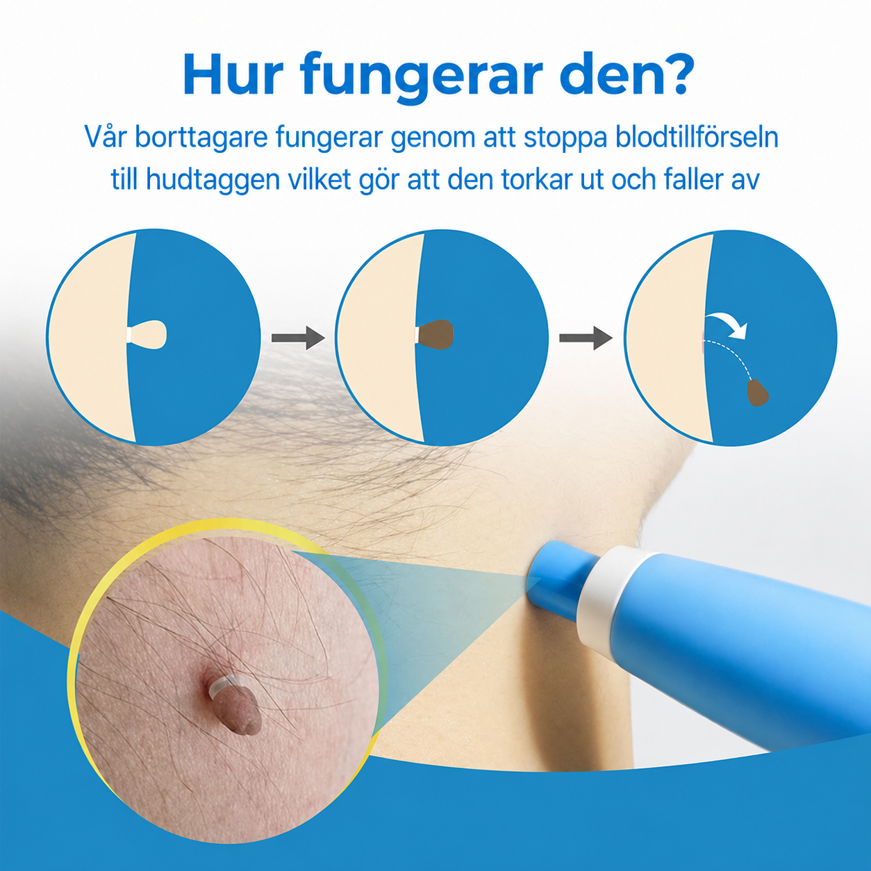 DermaTag™ | Bli av med hudflikar enkelt och hemma